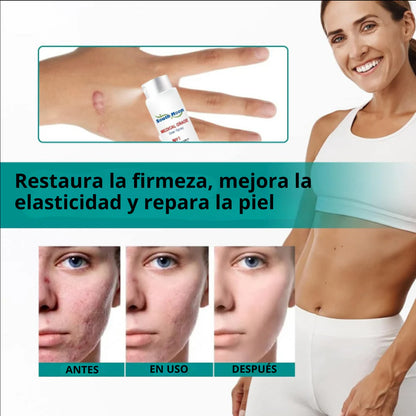 ScarSpray®: Spray avanzado para todo tipo de cicatrices: cicatrices de acné, cicatrices quirúrgicas y estrías